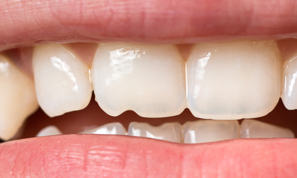 How To Fix A Chipped or Broken Tooth in Kitsilano