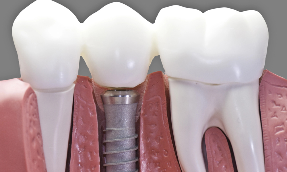 dental-implant-patient-cost-bc