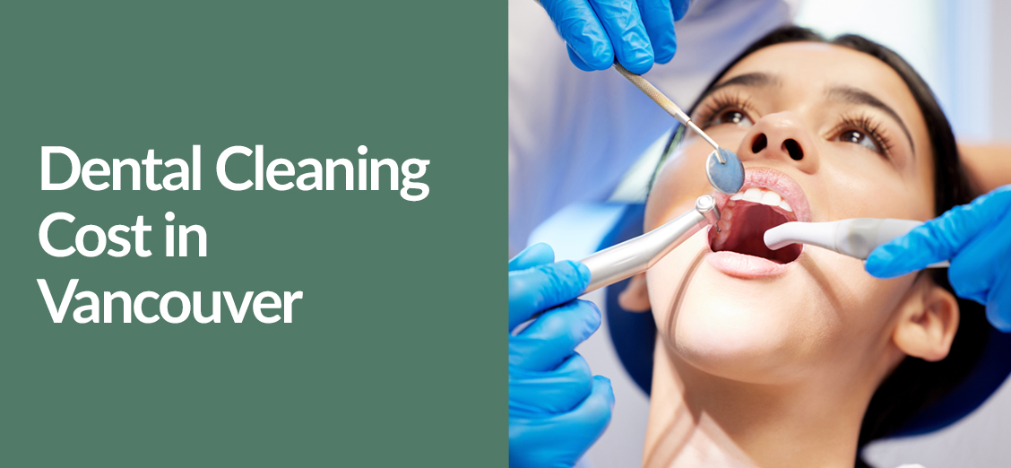 Dental Cleaning Cost in Vancouver