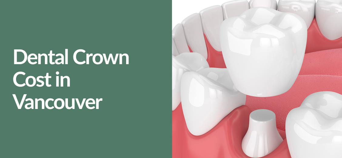Dental Crown Cost in Vancouver