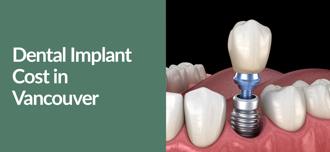 Dental Implant Cost in Vancouver