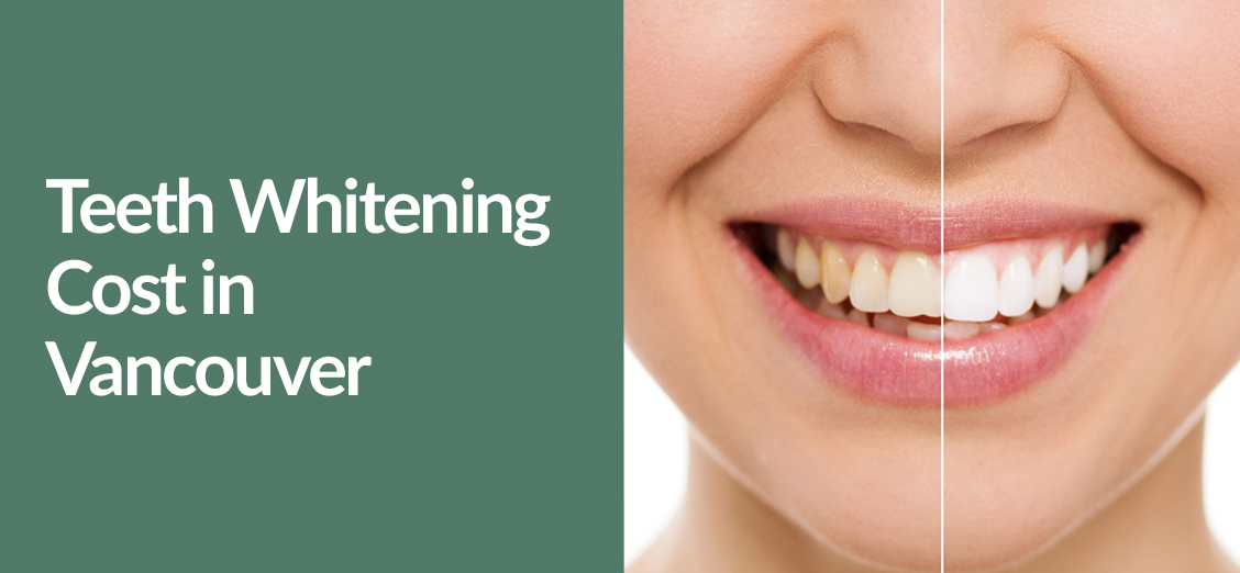 Teeth Whitening Cost in Vancouver