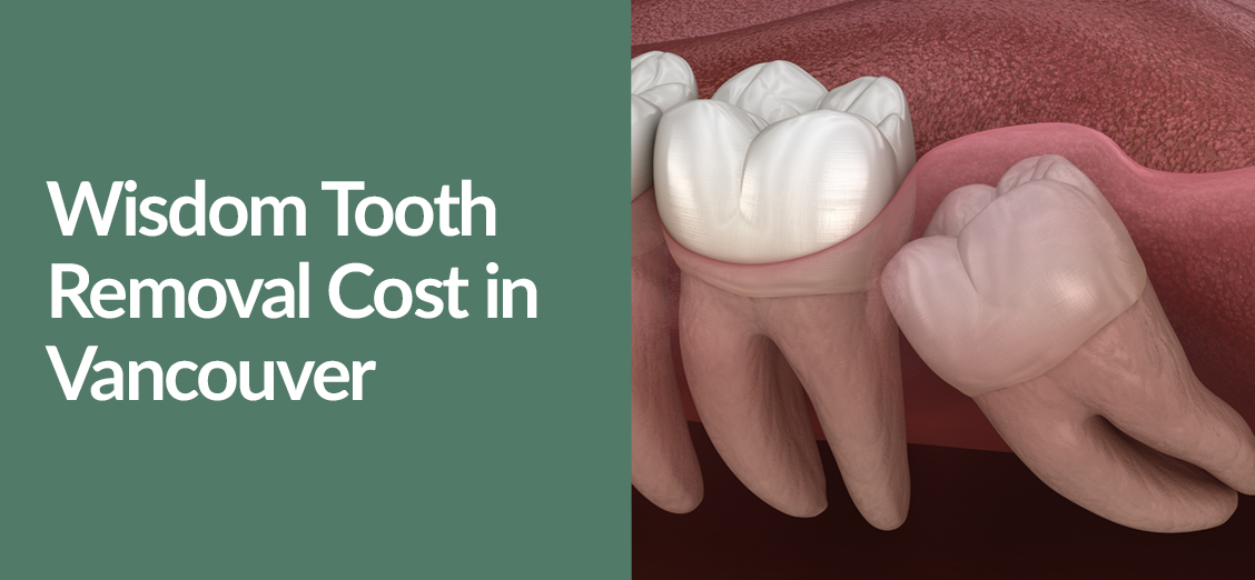 Wisdom Tooth Removal Cost in Vancouver