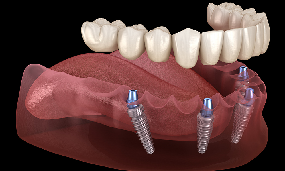 All on Four Dental Implants Vancouver