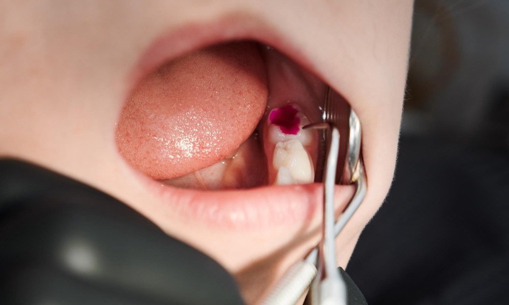 how do you know if you need root canal