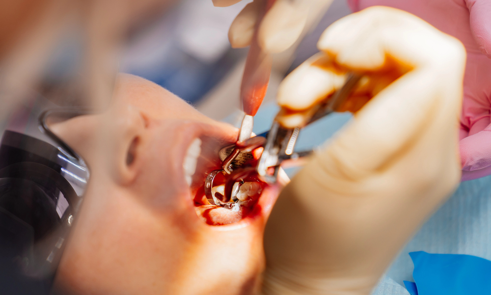 Granulation Tissue Wisdom Teeth