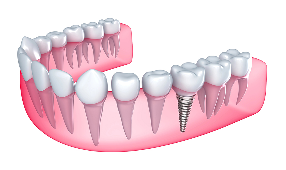 dental-implant-kitsilano