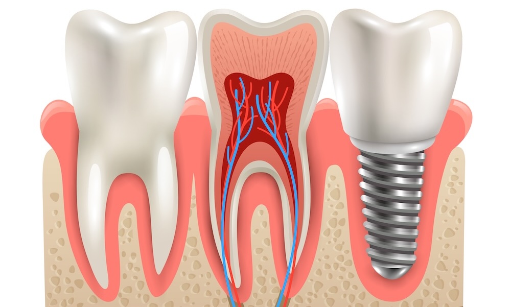 dental implant success rate