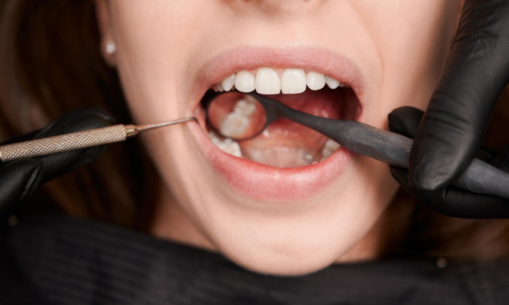 gumline cavity causes