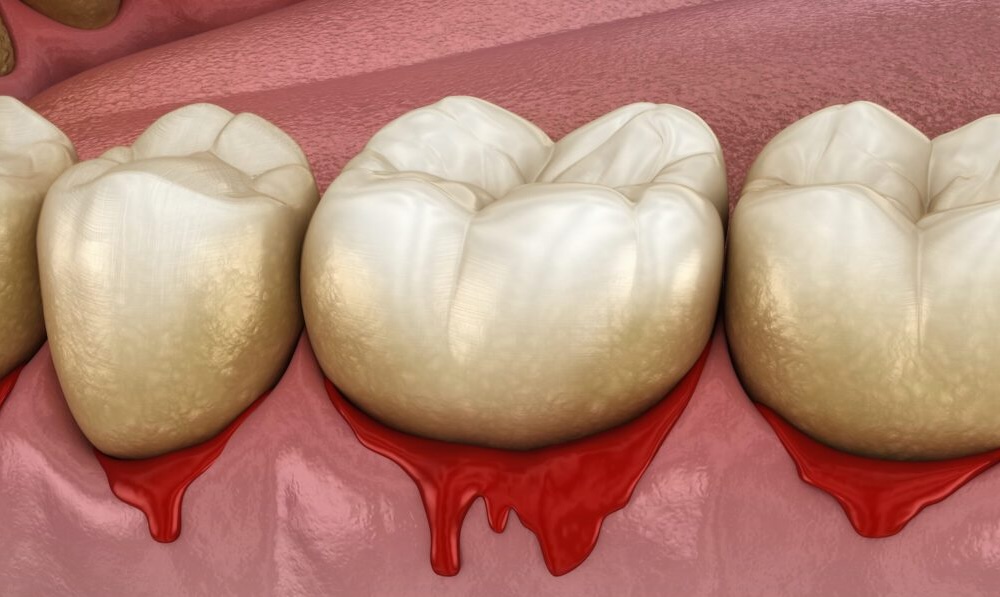 gumline cavity treatment