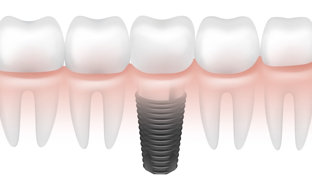 success rate for dental implants