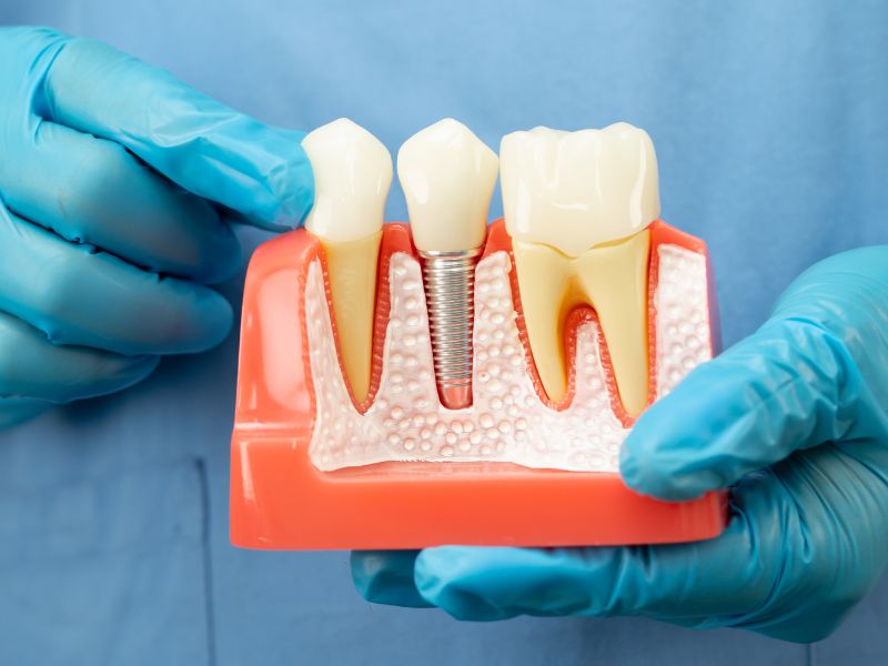 All-on-Four Dental Implants