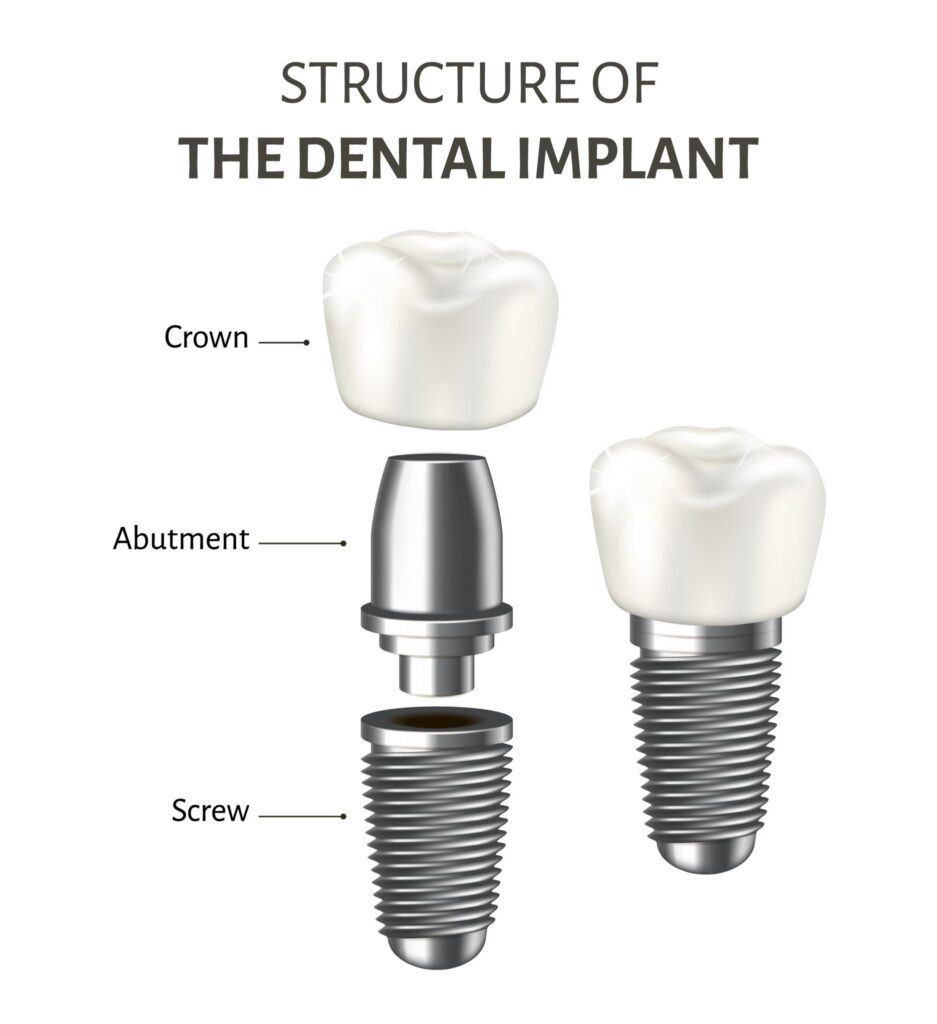 dental-implants-structure