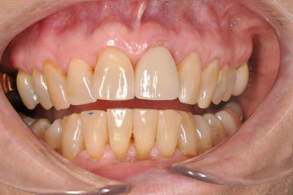 implant-after-1