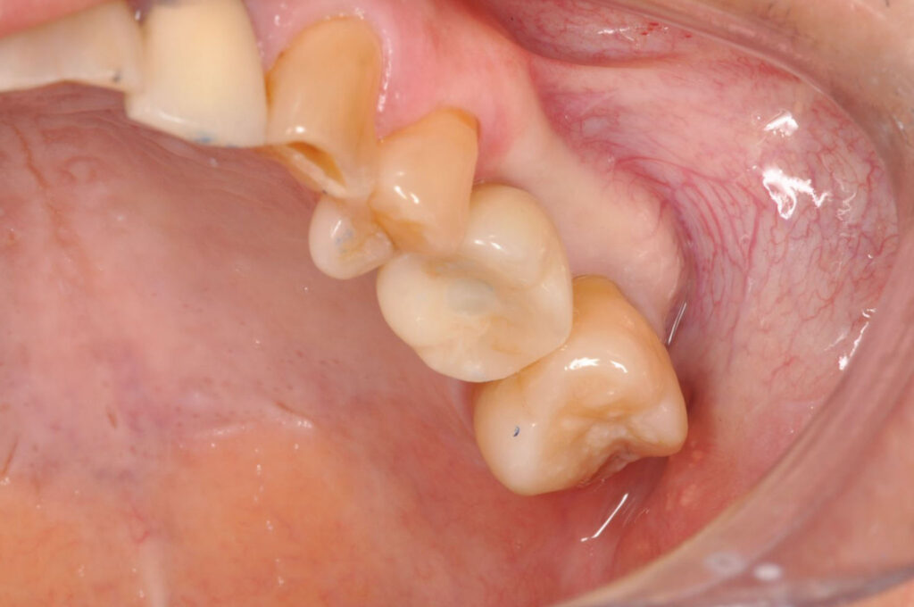 implant-after