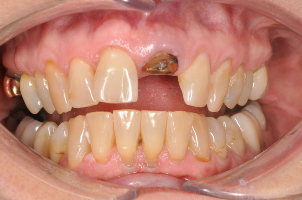 implant-before-1