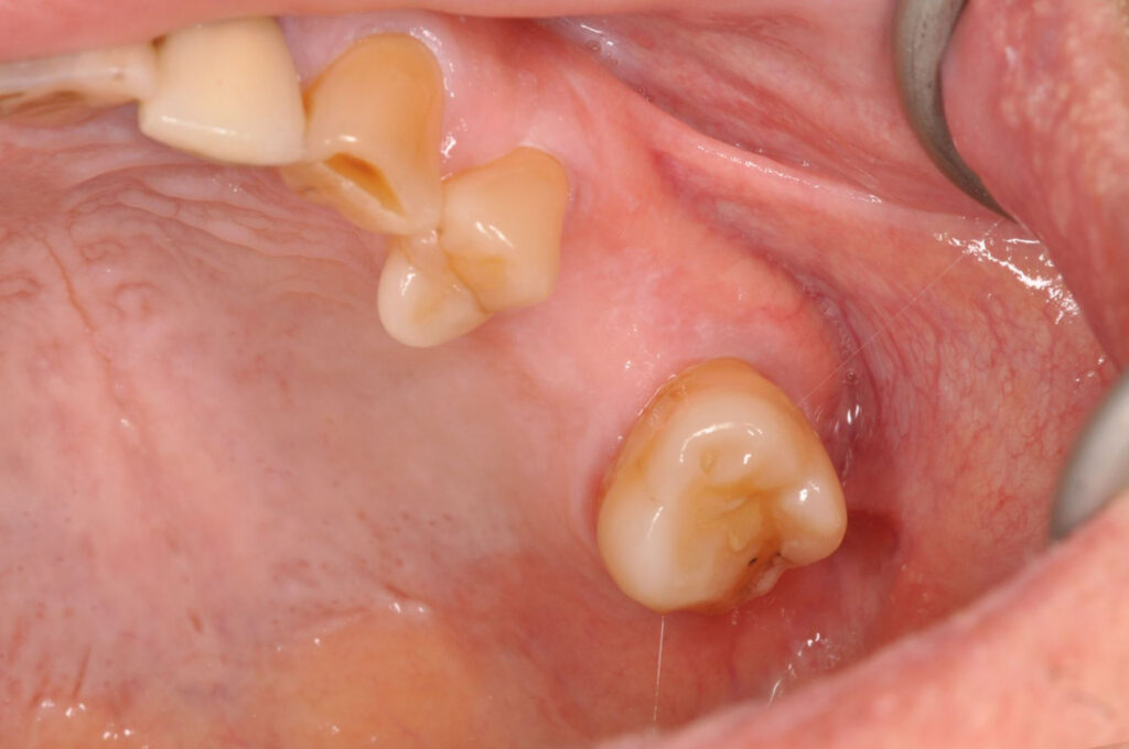 implant-before